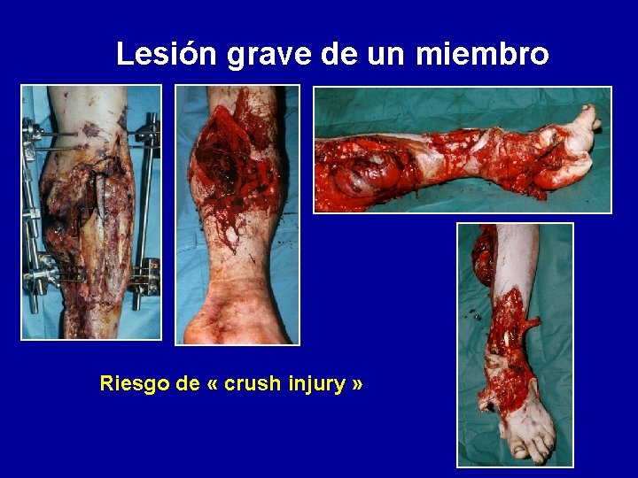 Lesión grave de un miembro Riesgo de « crush injury » 