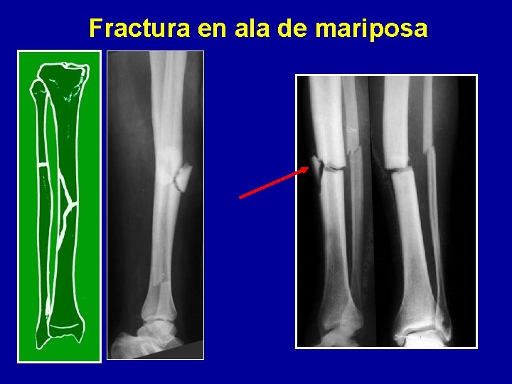 Fractura en ala de mariposa 