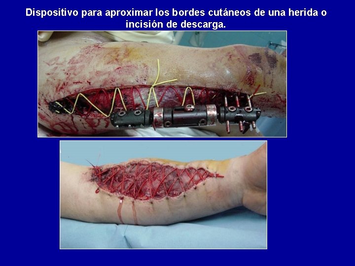 Dispositivo para aproximar los bordes cutáneos de una herida o incisión de descarga. 