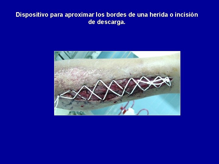 Dispositivo para aproximar los bordes de una herida o incisión de descarga. 