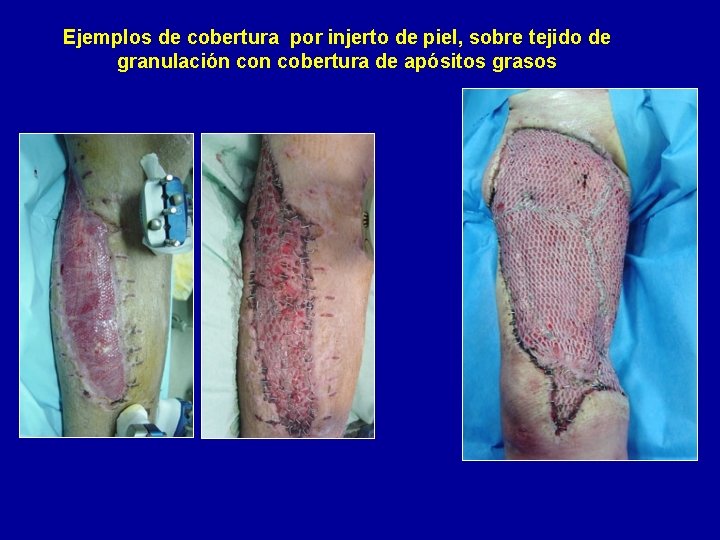 Ejemplos de cobertura por injerto de piel, sobre tejido de granulación cobertura de apósitos