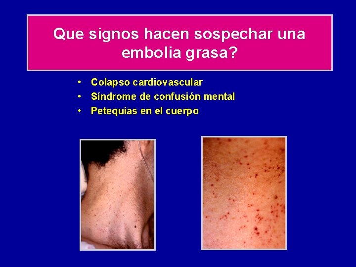 Que signos hacen sospechar una embolia grasa? • Colapso cardiovascular • Síndrome de confusión