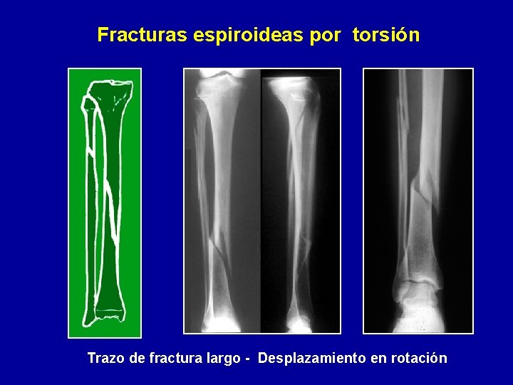 Fracturas espiroideas por torsión Trazo de fractura largo - Desplazamiento en rotación 