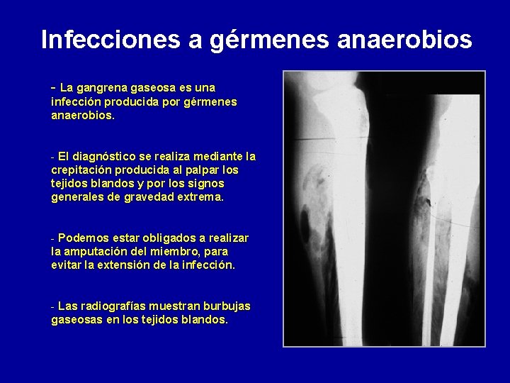 Infecciones a gérmenes anaerobios - La gangrena gaseosa es una infección producida por gérmenes