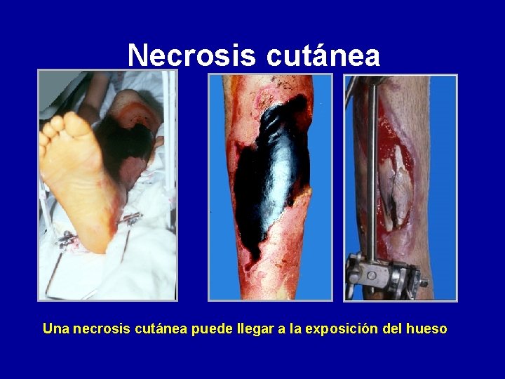 Necrosis cutánea Una necrosis cutánea puede llegar a la exposición del hueso 