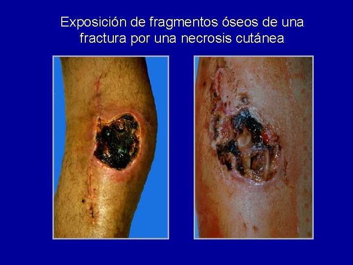 Exposición de fragmentos óseos de una fractura por una necrosis cutánea 