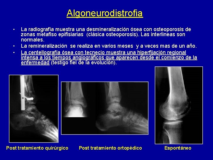 Algoneurodistrofia • • • La radiografía muestra una desmineralización ósea con osteoporosis de zonas