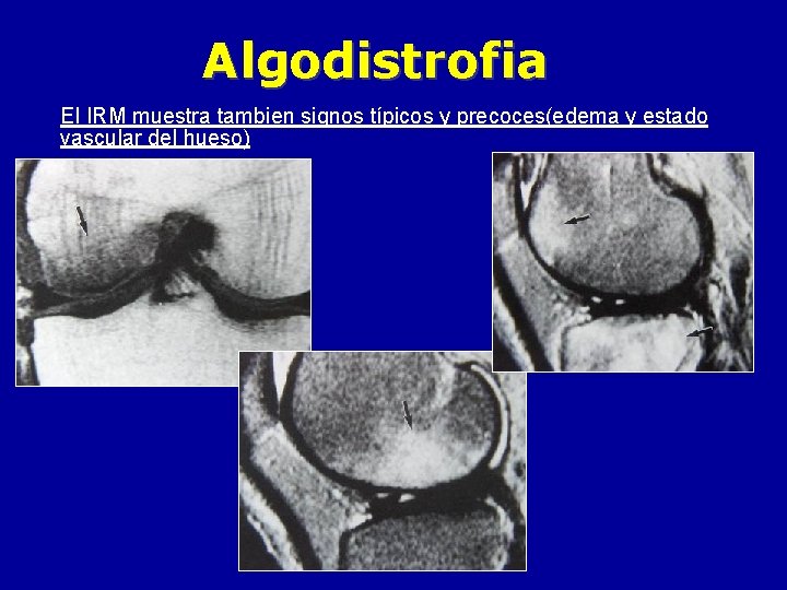 Algodistrofia El IRM muestra tambien signos típicos y precoces(edema y estado vascular del hueso)