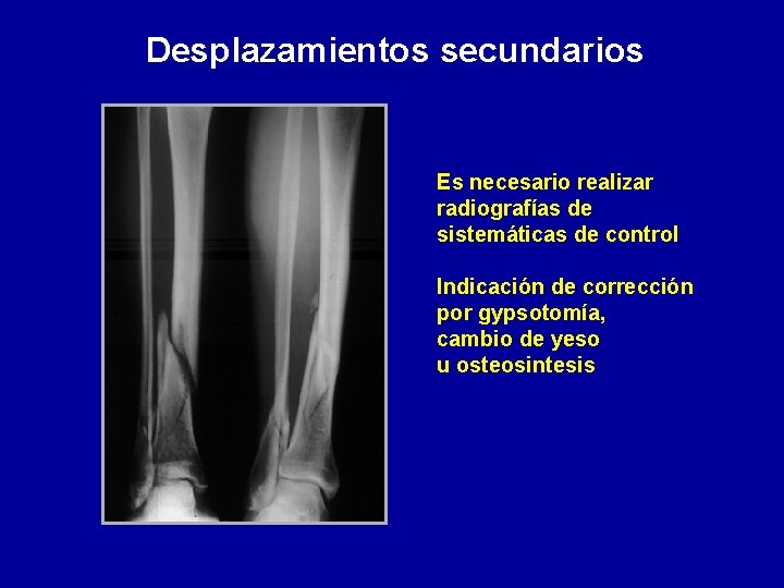 Desplazamientos secundarios Es necesario realizar radiografías de sistemáticas de control Indicación de corrección por