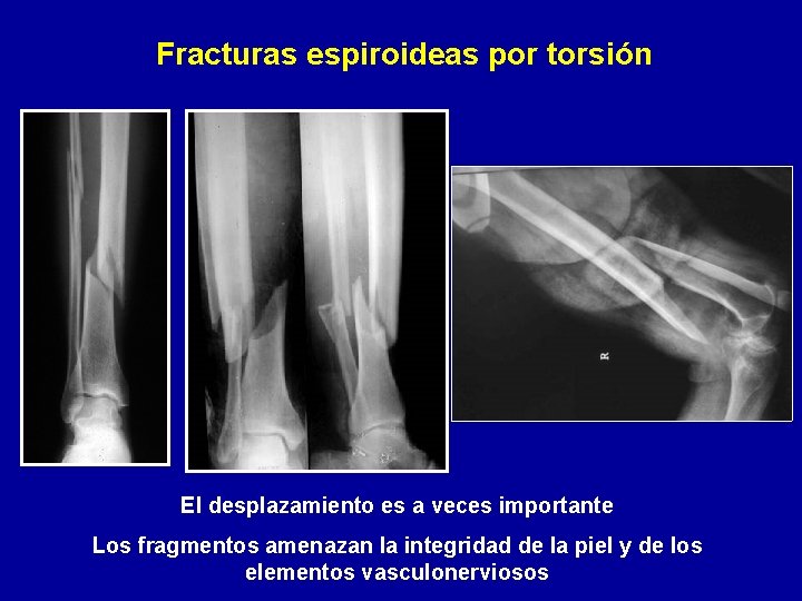 Fracturas espiroideas por torsión El desplazamiento es a veces importante Los fragmentos amenazan la