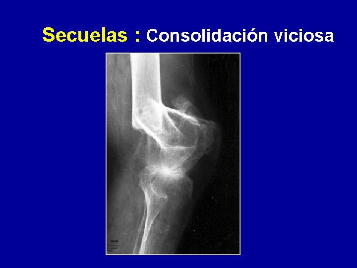 Secuelas : Consolidación viciosa 