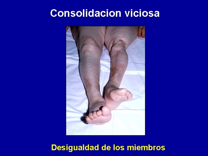 Consolidacion viciosa Desigualdad de los miembros 