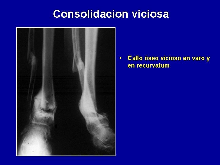 Consolidacion viciosa • Callo óseo vicioso en varo y en recurvatum 