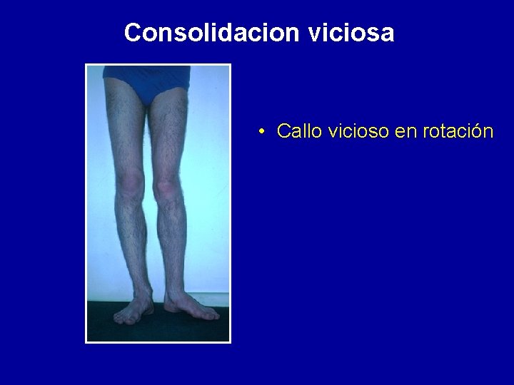 Consolidacion viciosa • Callo vicioso en rotación 
