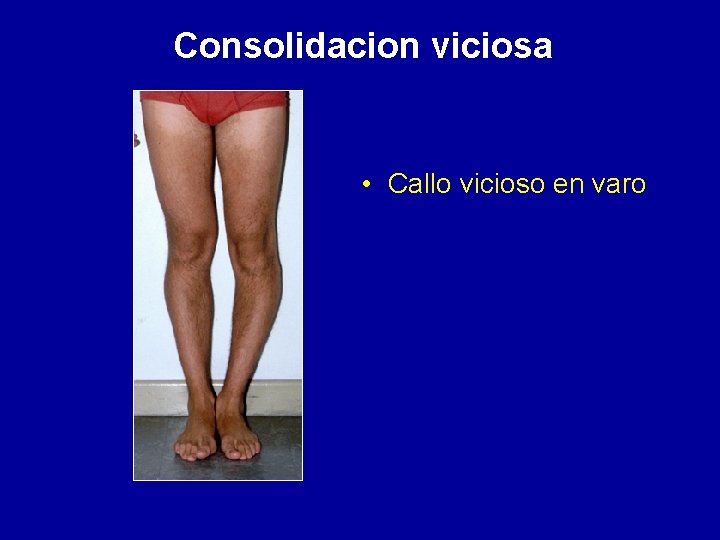 Consolidacion viciosa • Callo vicioso en varo 