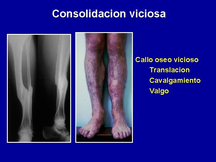Consolidacion viciosa Callo oseo vicioso Translacion Cavalgamiento Valgo 