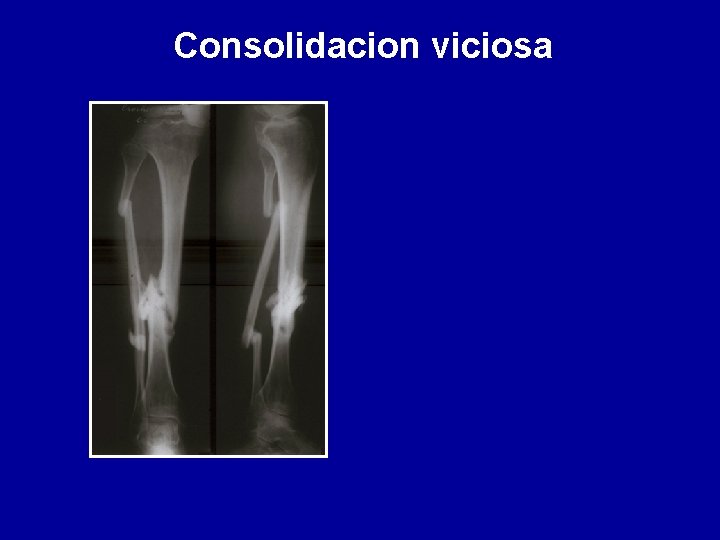Consolidacion viciosa 