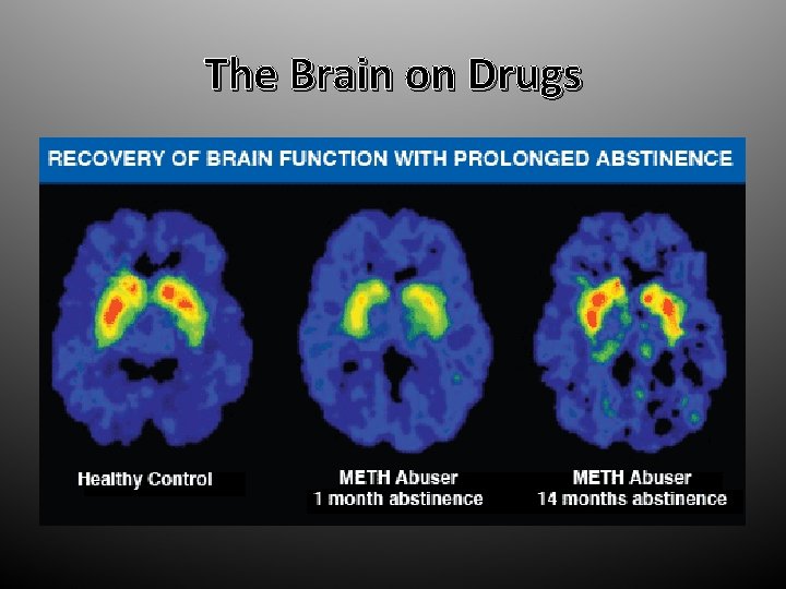The Brain on Drugs 