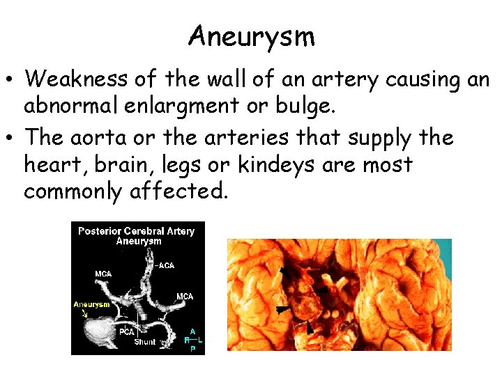 Aneurysm • Weakness of the wall of an artery causing an abnormal enlargment or