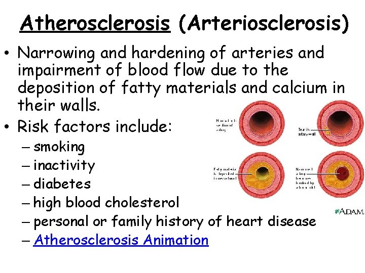 Atherosclerosis (Arteriosclerosis) • Narrowing and hardening of arteries and impairment of blood flow due