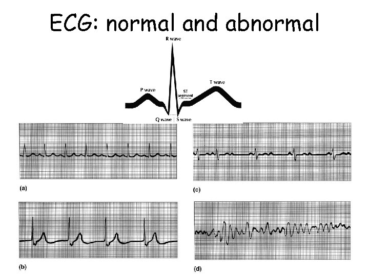 ECG: normal and abnormal 