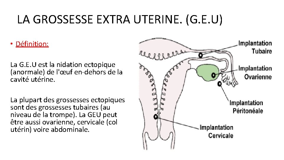 LA GROSSESSE EXTRA UTERINE. (G. E. U) • Définition: La G. E. U est