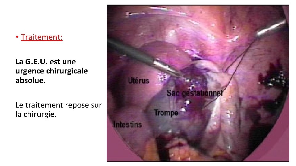  • Traitement: La G. E. U. est une urgence chirurgicale absolue. Le traitement