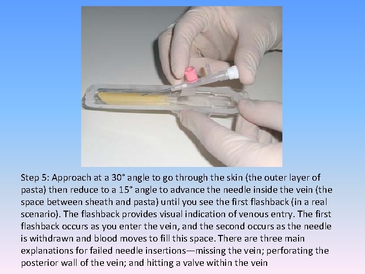 Step 5: Approach at a 30° angle to go through the skin (the outer