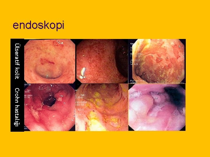 endoskopi Ülseratif kolit Crohn hastalığı 