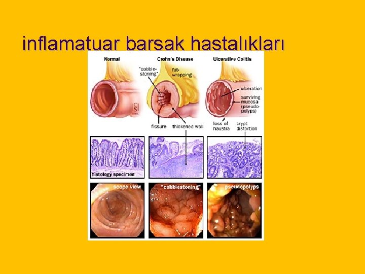 inflamatuar barsak hastalıkları 