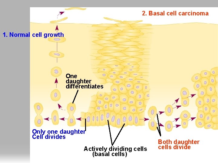 2. Basal cell carcinoma 1. Normal cell growth One daughter differentiates Only one daughter