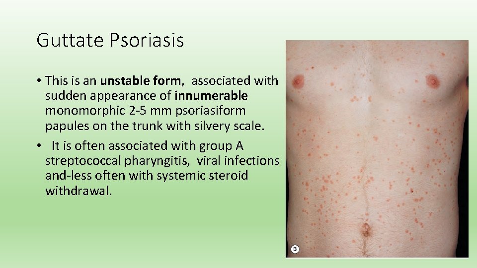 Guttate Psoriasis • This is an unstable form, associated with sudden appearance of innumerable