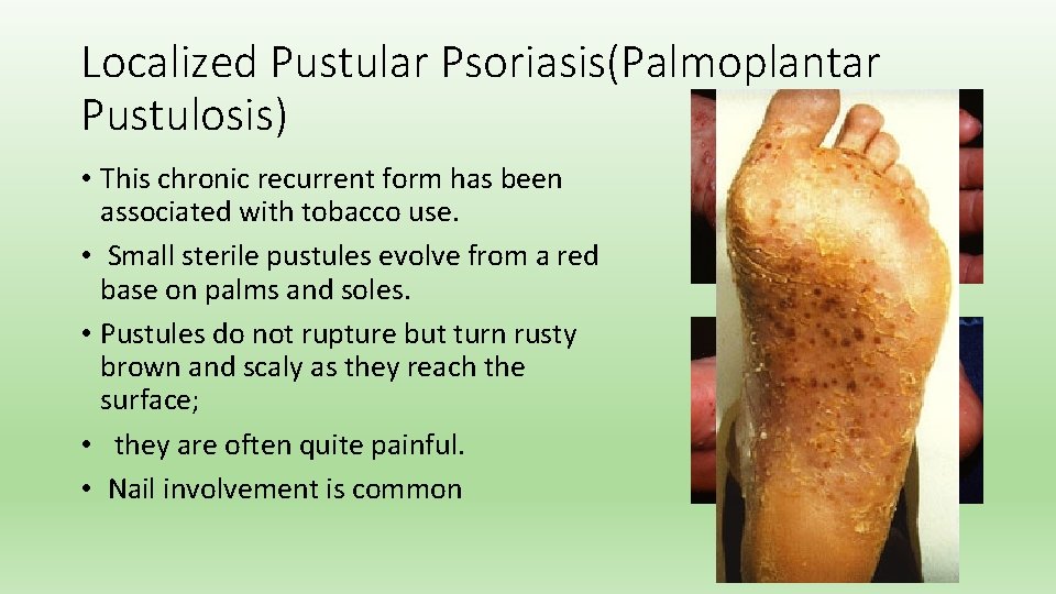 Localized Pustular Psoriasis(Palmoplantar Pustulosis) • This chronic recurrent form has been associated with tobacco