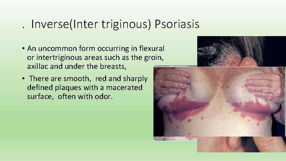 . Inverse(Inter triginous) Psoriasis • An uncommon form occurring in flexural or intertriginous areas