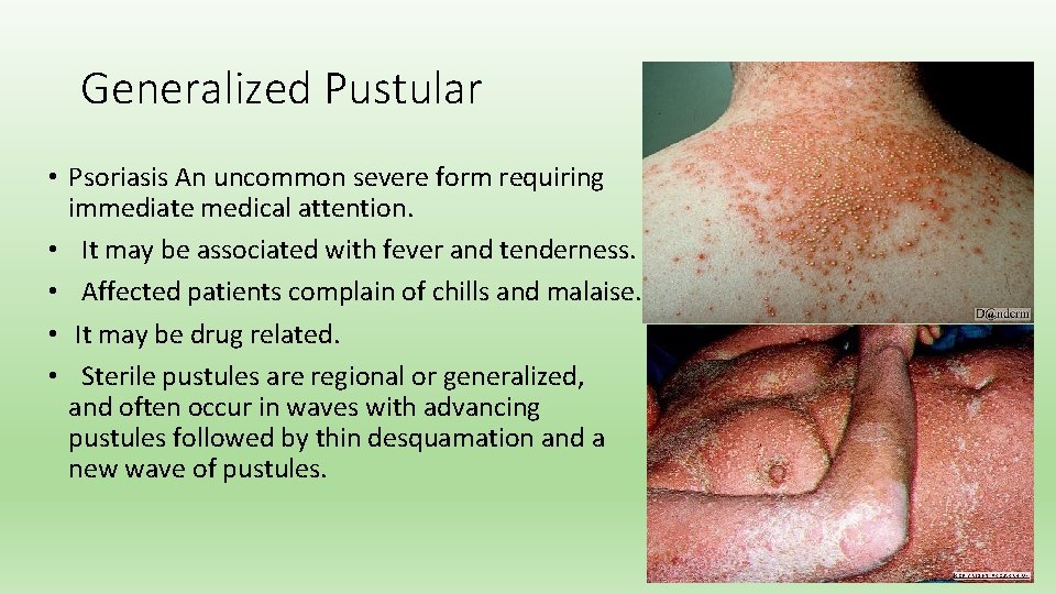 Generalized Pustular • Psoriasis An uncommon severe form requiring immediate medical attention. • It