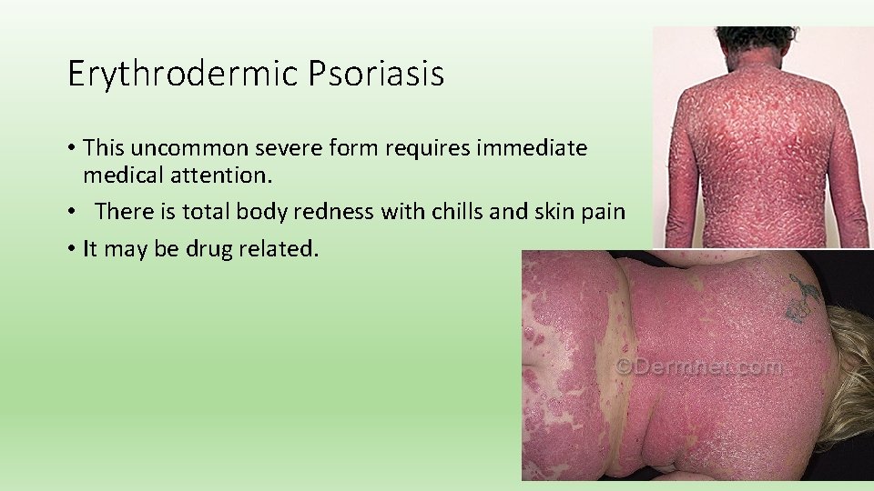 Erythrodermic Psoriasis • This uncommon severe form requires immediate medical attention. • There is
