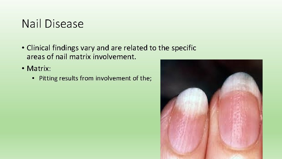 Nail Disease • Clinical findings vary and are related to the specific areas of