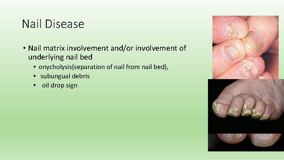 Nail Disease • Nail matrix involvement and/or involvement of underlying nail bed • onycholysis(separation