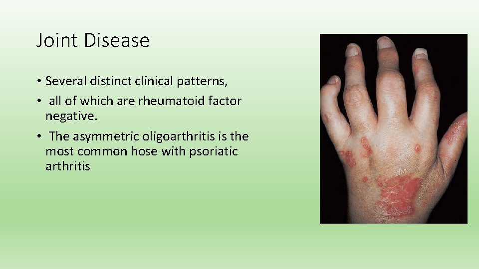 Joint Disease • Several distinct clinical patterns, • all of which are rheumatoid factor