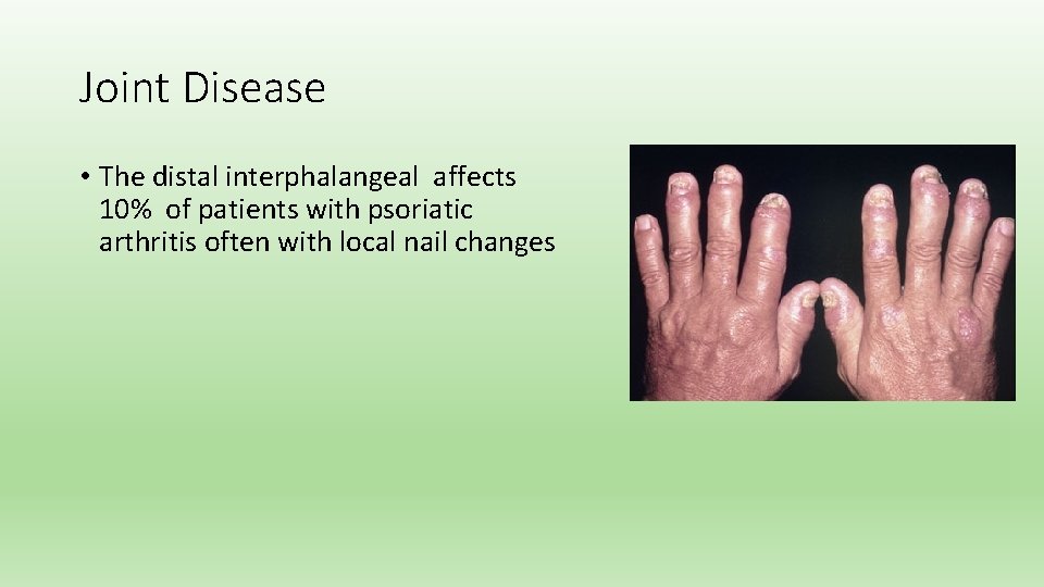 Joint Disease • The distal interphalangeal affects 10% of patients with psoriatic arthritis often