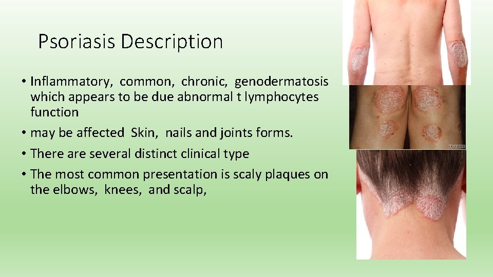 Psoriasis Description • Inflammatory, common, chronic, genodermatosis which appears to be due abnormal t