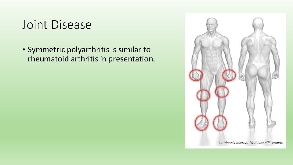Joint Disease • Symmetric polyarthritis is similar to rheumatoid arthritis in presentation. 