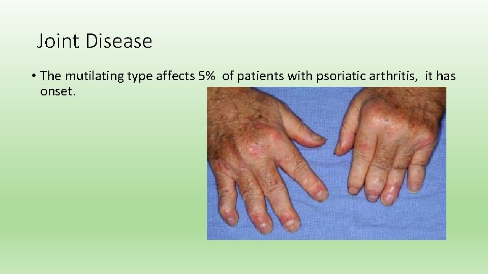 Joint Disease • The mutilating type affects 5% of patients with psoriatic arthritis, it