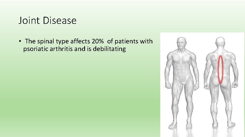 Joint Disease • The spinal type affects 20% of patients with psoriatic arthritis and