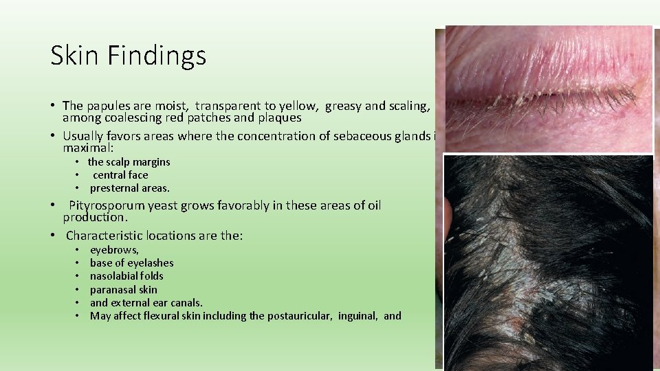 Skin Findings • The papules are moist, transparent to yellow, greasy and scaling, among