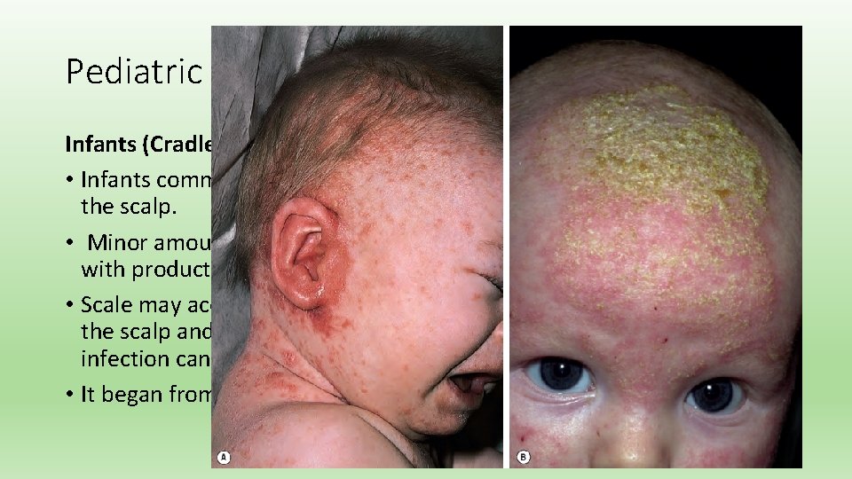 Pediatric Considerations(cradle cap) Infants (Cradle Cap) • Infants commonly develop a greasy adherent scale