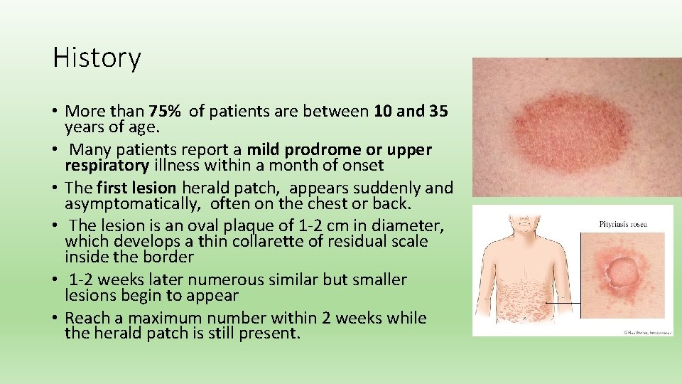 History • More than 75% of patients are between 10 and 35 years of