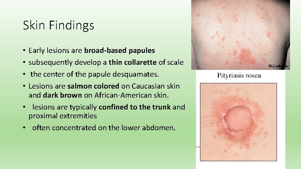 Skin Findings Early lesions are broad-based papules subsequently develop a thin collarette of scale