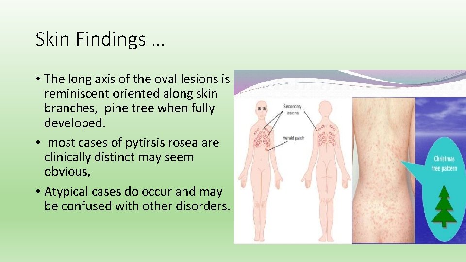 Skin Findings … • The long axis of the oval lesions is reminiscent oriented