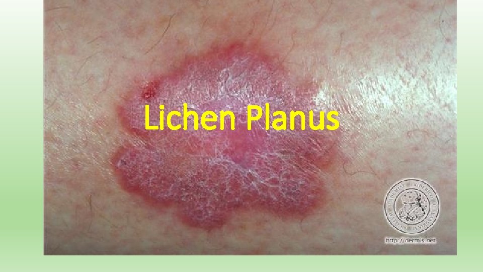 Lichen Planus 